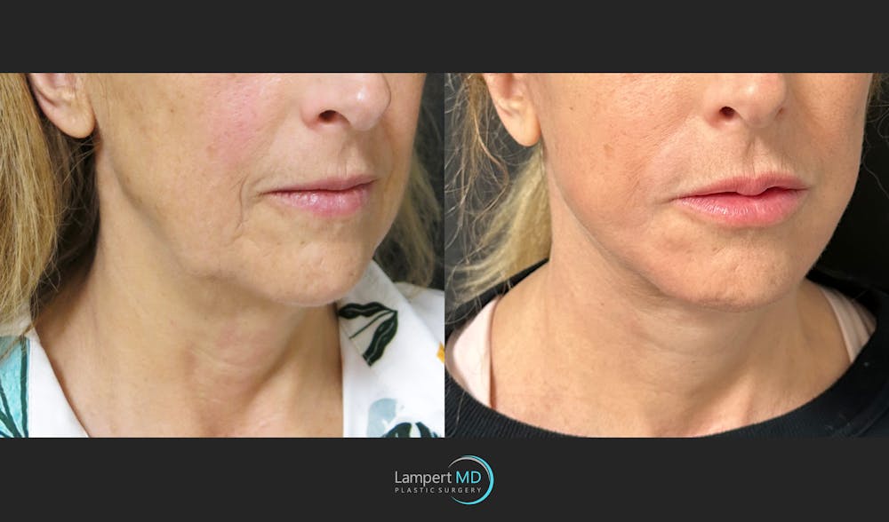 Face & Neck Lift Before & After Gallery - Patient 235124 - Image 2
