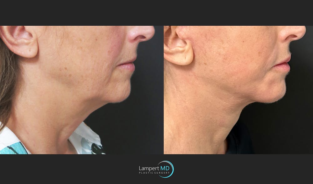 Face & Neck Lift Before & After Gallery - Patient 235124 - Image 3