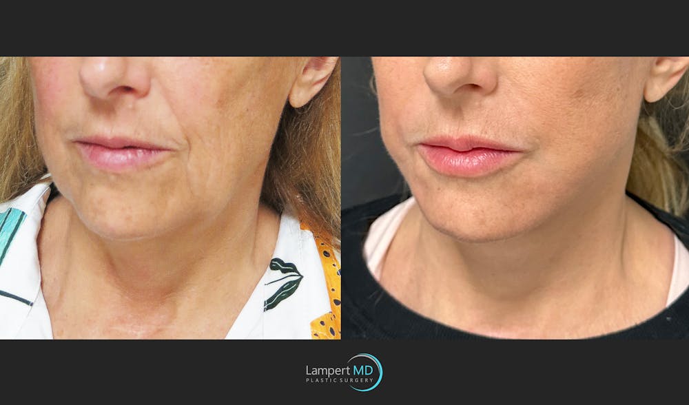 Face & Neck Lift Before & After Gallery - Patient 235124 - Image 4