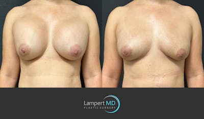 Breast Reconstruction Before & After Gallery - Patient 122909018 - Image 1