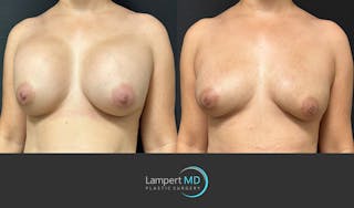 Breast Reconstruction Before & After Gallery - Patient 122909018 - Image 2