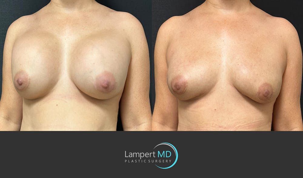 Breast Reconstruction Before & After Gallery - Patient 122909018 - Image 2