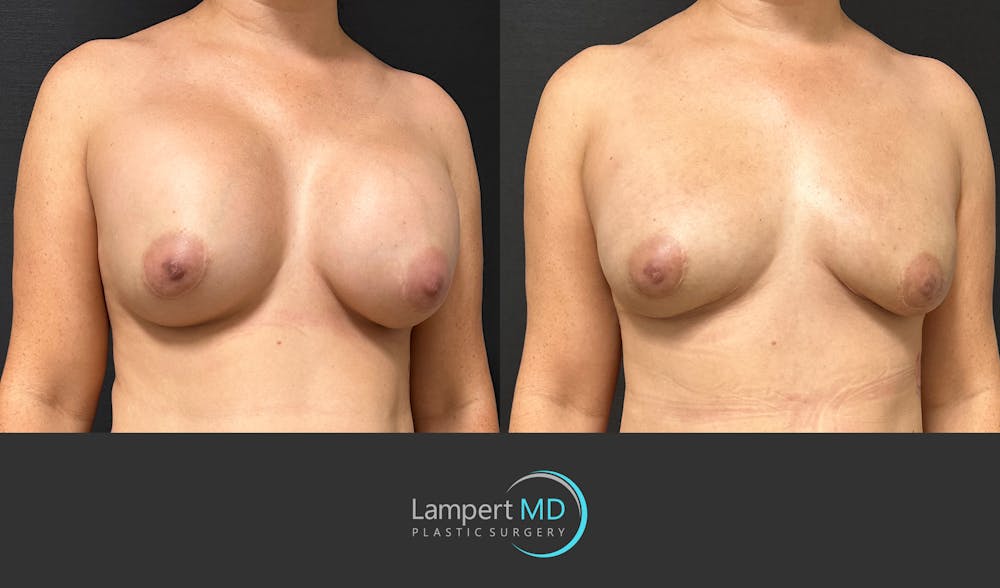 Breast Reconstruction Before & After Gallery - Patient 122909018 - Image 3