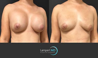 Breast Reconstruction Before & After Gallery - Patient 122909018 - Image 3