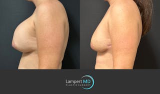 Breast Reconstruction Before & After Gallery - Patient 122909018 - Image 4