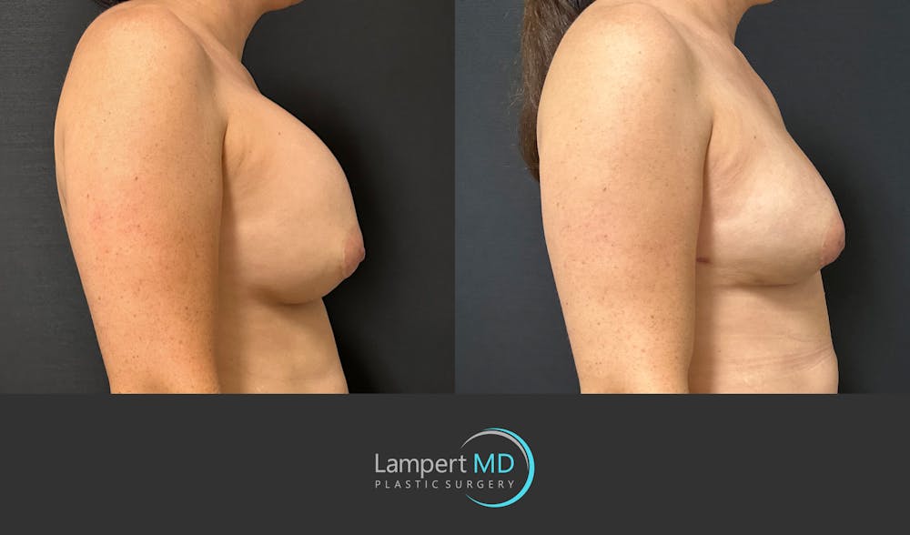 Breast Reconstruction Before & After Gallery - Patient 122909018 - Image 5