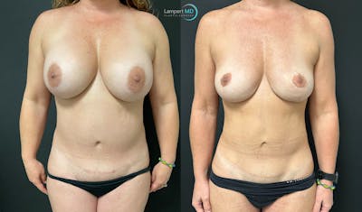 Breast Explant Before & After Gallery - Patient 148734396 - Image 1