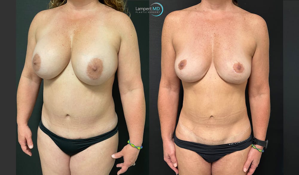 Breast Explant Before & After Gallery - Patient 148734396 - Image 2