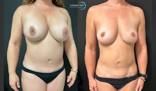 Breast Explant Before & After Gallery - Patient 148734396 - Image 3