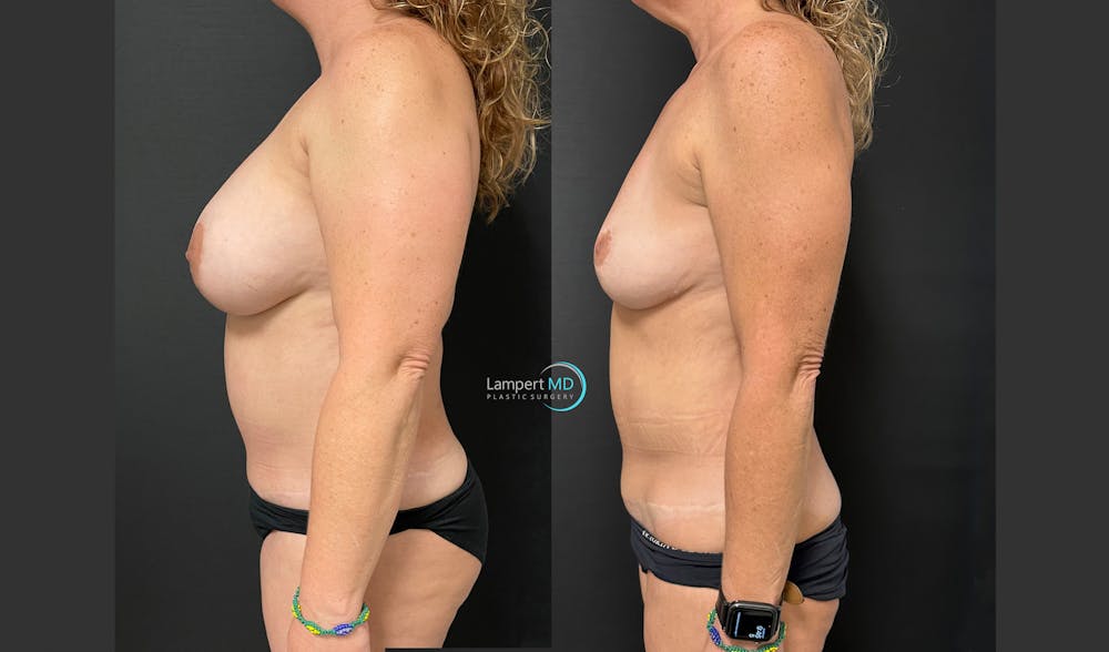 Breast Explant Before & After Gallery - Patient 148734396 - Image 4