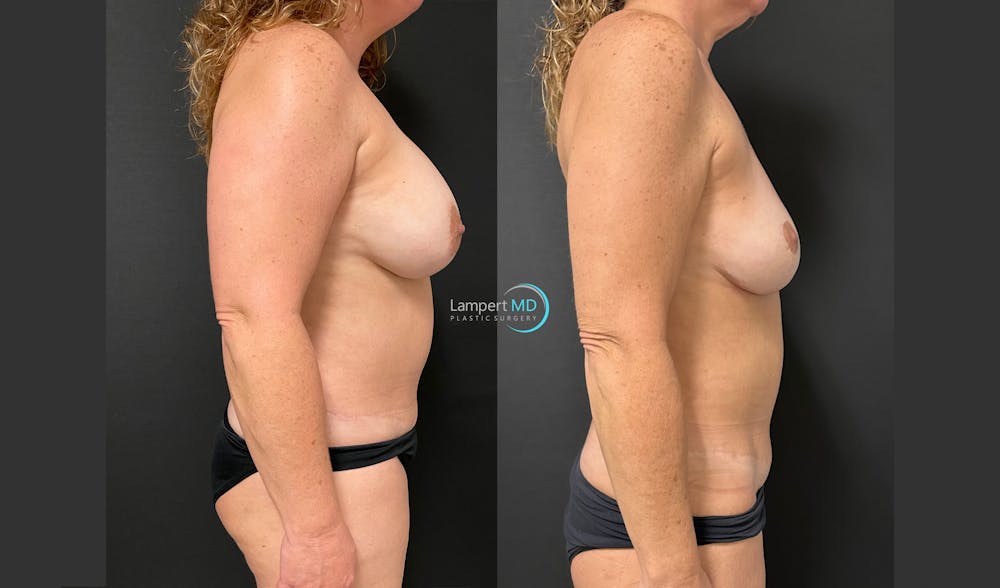 Breast Fat Transfer Before & After Gallery - Patient 340996 - Image 5