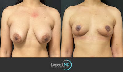 Breast Explant Before & After Gallery - Patient 365043 - Image 1