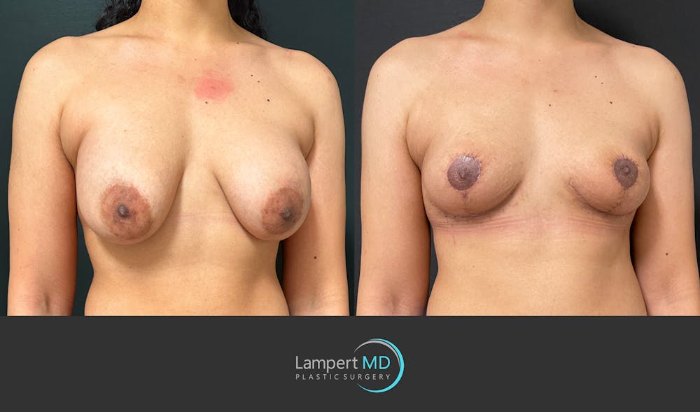 Breast Explant Before & After Gallery - Patient 365043 - Image 2