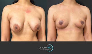 Breast Lift Before & After Gallery - Patient 359533 - Image 2