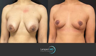 Breast Explant Before & After Gallery - Patient 365043 - Image 3