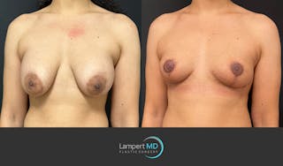 Breast Lift Before & After Gallery - Patient 359533 - Image 3