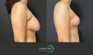 Breast Explant Before & After Gallery - Patient 365043 - Image 4