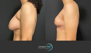 Breast Explant Before & After Gallery - Patient 365043 - Image 5