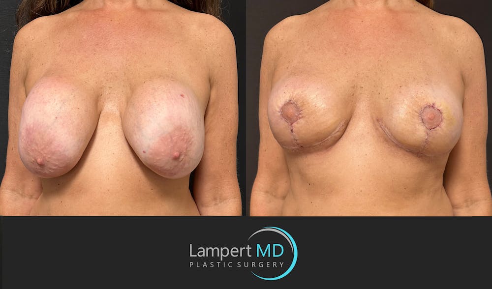 Breast Explant Before & After Gallery - Patient 157606 - Image 2