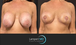 Breast Explant Before & After Gallery - Patient 157606 - Image 2