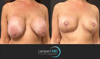 Breast Explant Before & After Gallery - Patient 157606 - Image 3