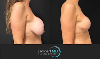 Breast Explant Before & After Gallery - Patient 157606 - Image 5