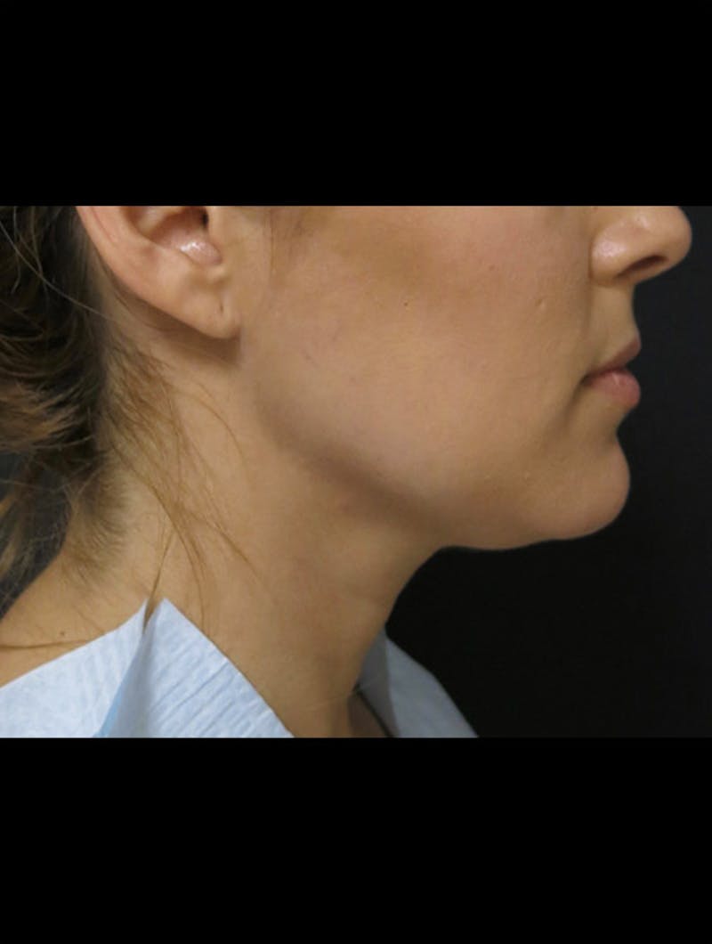 Chin Before & After Gallery - Patient 366342 - Image 1