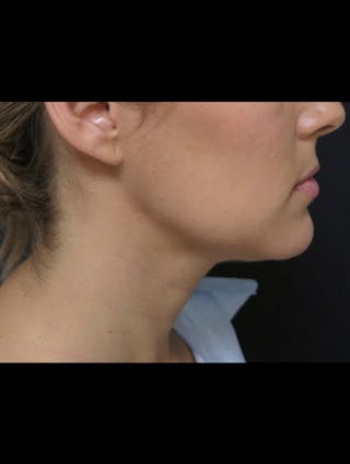Chin Before & After Gallery - Patient 366342 - Image 2