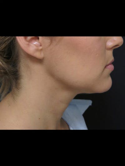 Chin Before & After Gallery - Patient 366342 - Image 2