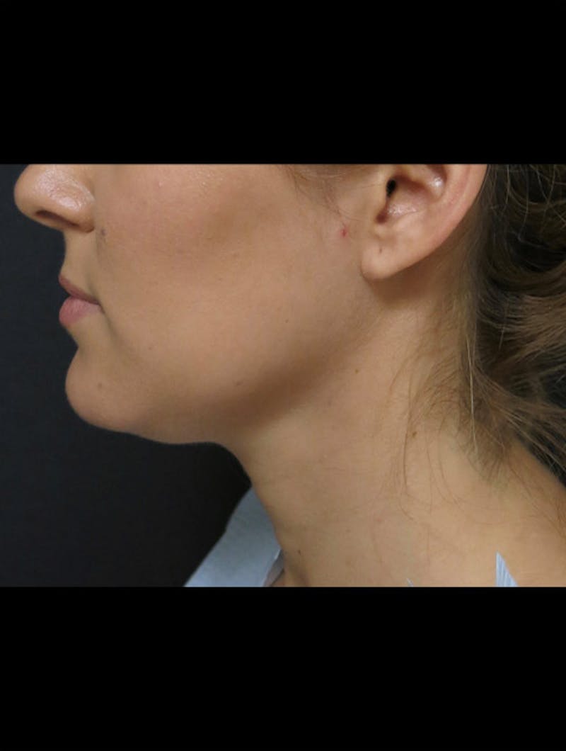 Chin Before & After Gallery - Patient 366342 - Image 3