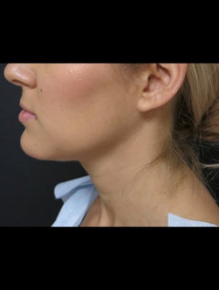 Chin Before & After Gallery - Patient 366342 - Image 4