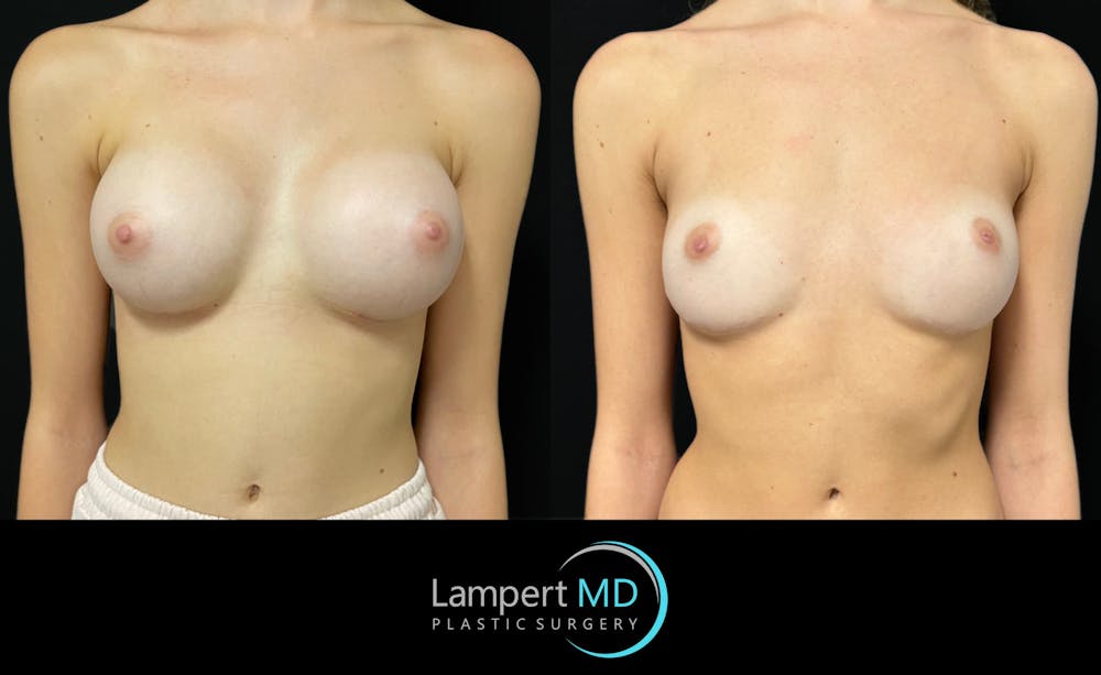 Breast Explant Before & After Gallery - Patient 404647 - Image 1