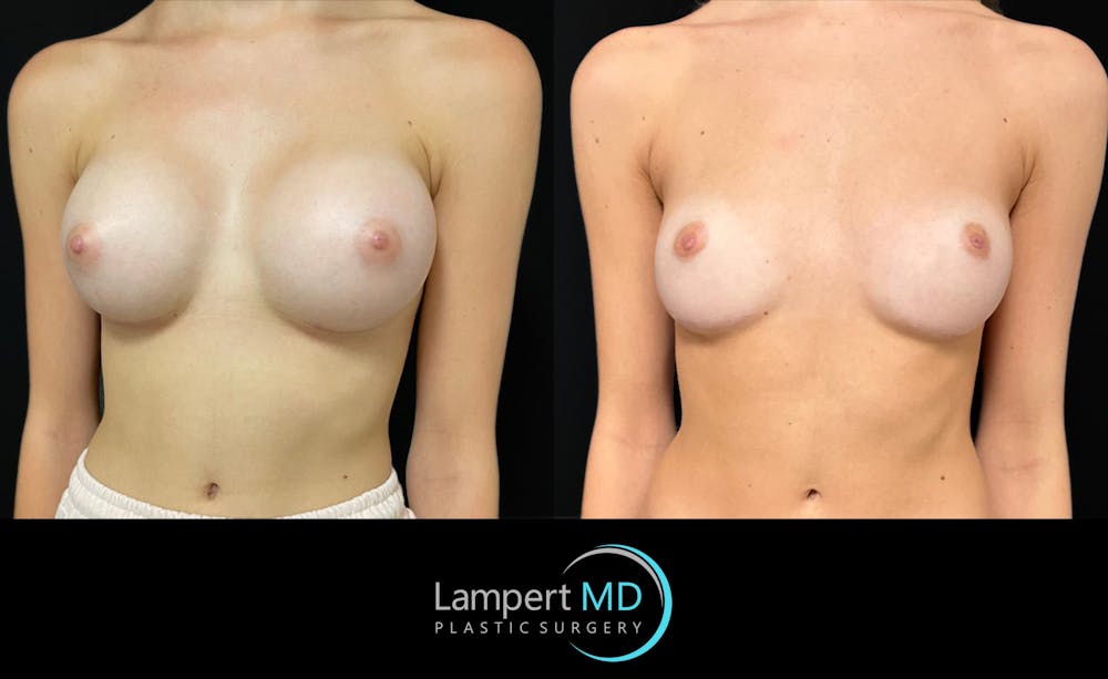 Breast Explant Before & After Gallery - Patient 404647 - Image 3