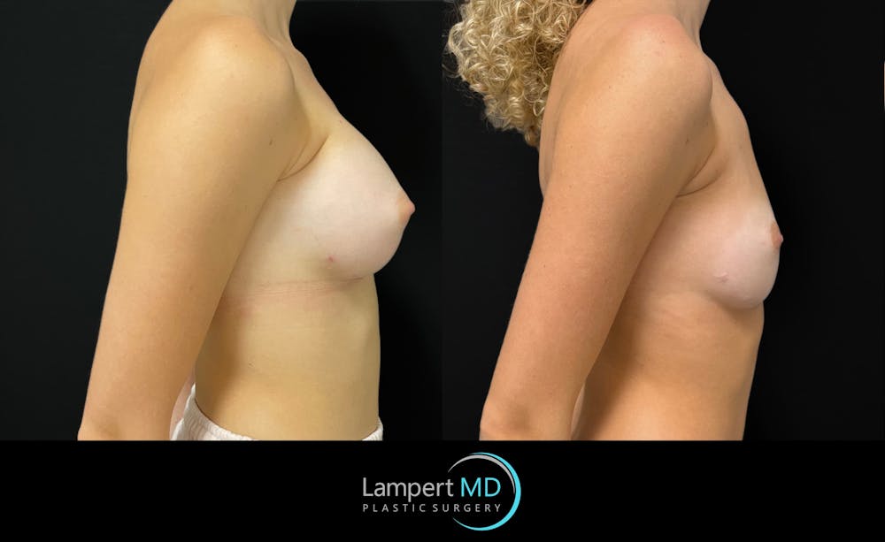 Breast Explant Before & After Gallery - Patient 404647 - Image 4