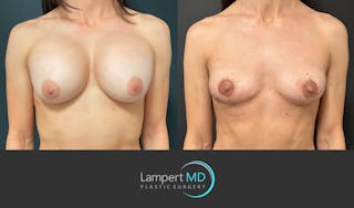 Breast Explant Before & After Gallery - Patient 214775 - Image 1