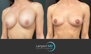 Breast Explant Before & After Gallery - Patient 214775 - Image 2