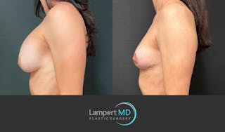 Breast Explant Before & After Gallery - Patient 214775 - Image 4
