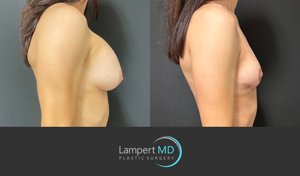 Breast Explant Before & After Gallery - Patient 214775 - Image 5