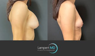 Breast Explant Before & After Gallery - Patient 214775 - Image 5