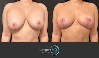 Breast Explant Before & After Gallery - Patient 273893 - Image 1