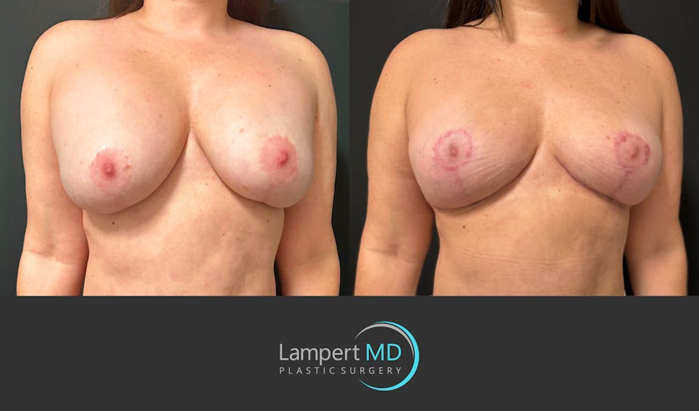 Breast Explant Before & After Gallery - Patient 273893 - Image 2