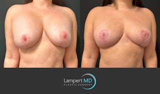 Breast Explant Before & After Gallery - Patient 273893 - Image 2