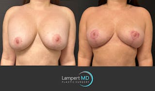 Breast Explant Before & After Gallery - Patient 273893 - Image 3