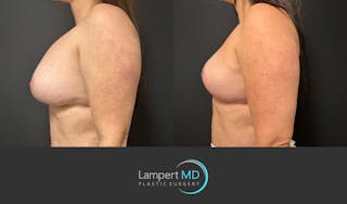 Breast Explant Before & After Gallery - Patient 273893 - Image 4