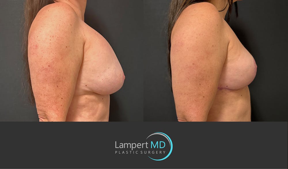 Breast Explant Before & After Gallery - Patient 273893 - Image 5