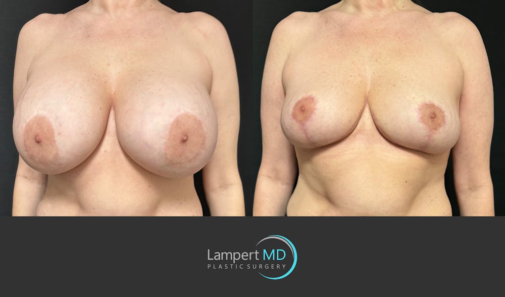 Breast Explant Before & After Gallery - Patient 274383 - Image 2