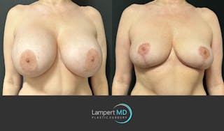 Breast Explant Before & After Gallery - Patient 274383 - Image 3