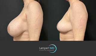 Breast Explant Before & After Gallery - Patient 274383 - Image 4