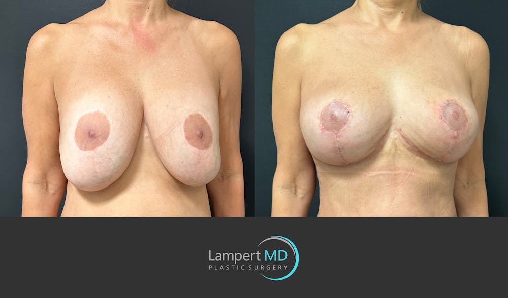 Breast Fat Transfer Before & After Gallery - Patient 194947 - Image 2