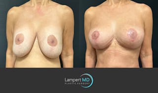Breast Fat Transfer Before & After Gallery - Patient 194947 - Image 3